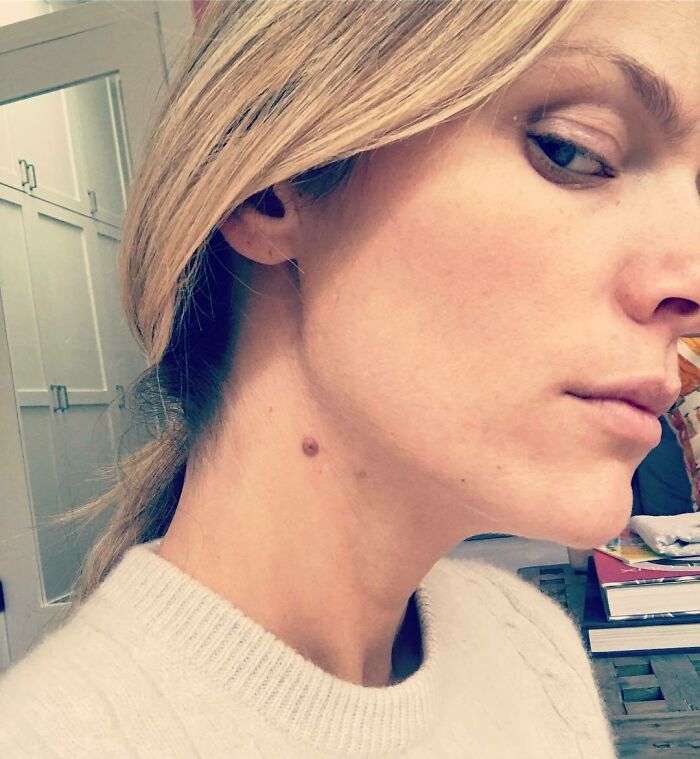 Brooklyn Decker Shared This Photo Of A Neck Mole That Her Kid Thinks Is A Nipple