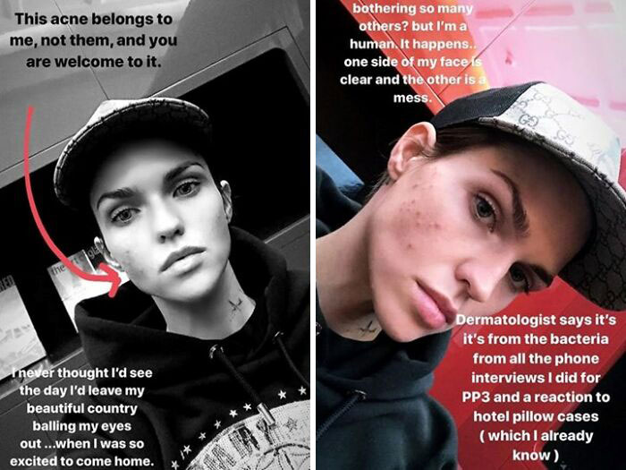 When Ruby Rose Showed Us That Even Famous People Break Out, Too