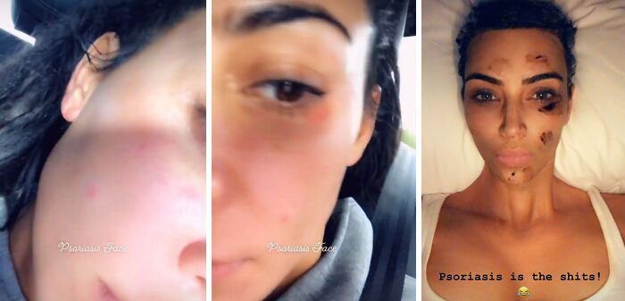 When Kim Kardashian Shared Photos Of Her "Psoriasis Face" And Went On To Call The Condition "The Shits"