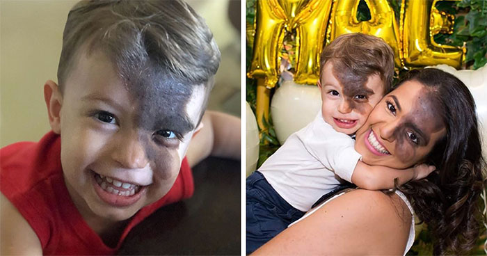 Societal Judgement Towards Enzo’s Mark On His Face Encouraged His Mom To Replicate It On Hers To Walk In His Shoes