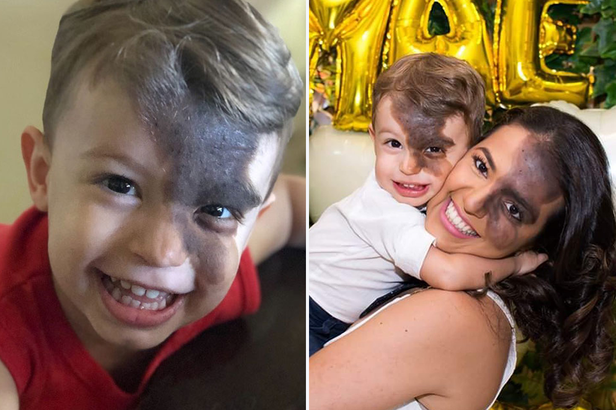 Societal Judgement Towards Enzo's Mark On His Face Encouraged His Mom To Replicate It On Hers To Walk In His Shoes | Bored Panda