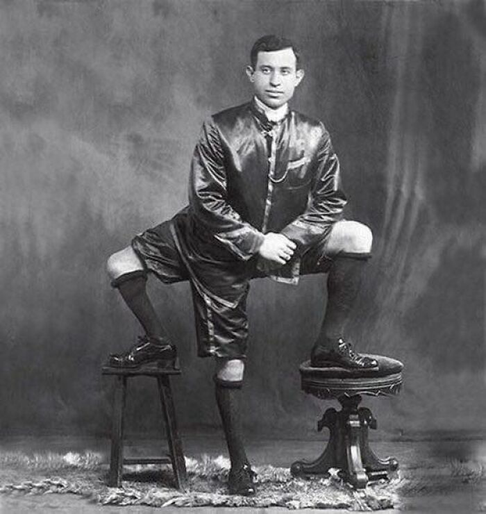 Frank Lentini, An Owner Of 3 Legs, 4 Feet, 16 Toes, And 2 Functioning Sets Of Genitals