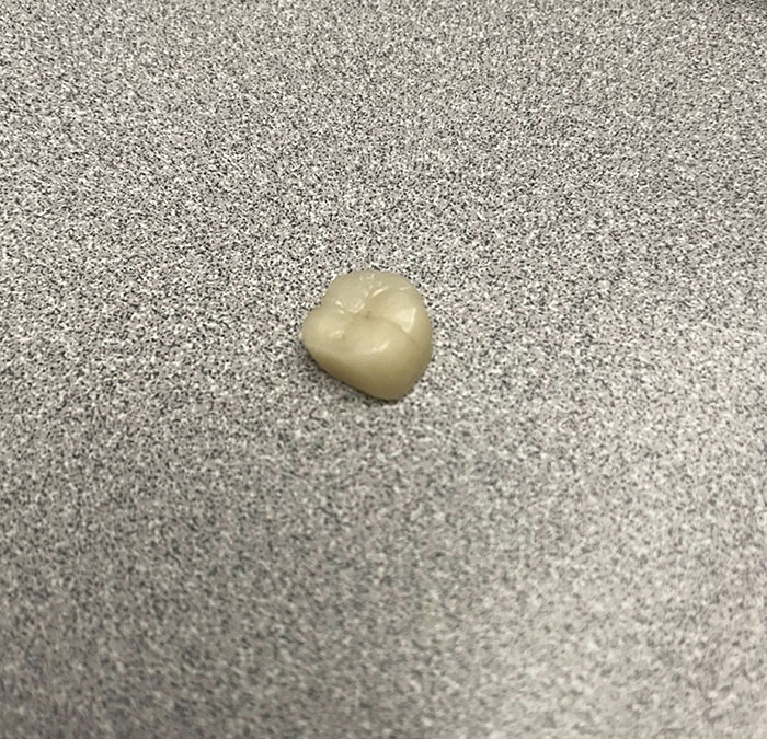 My Tooth Crown Fell Out While I Was Taking A Call At Work