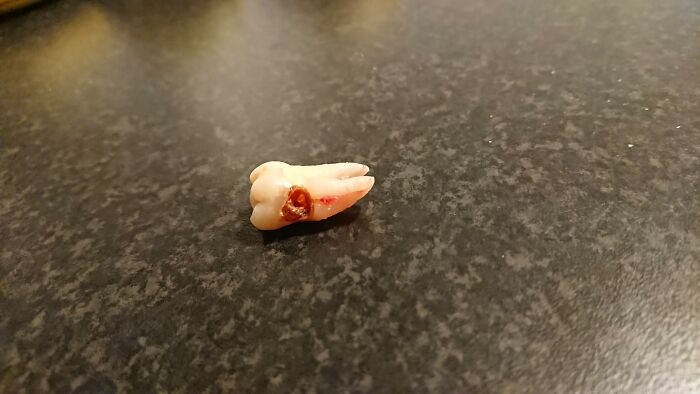 Went To The Dentist Cause My Wisdom Tooth Was Hurting. Turns Out It Was The Tooth Next To It
