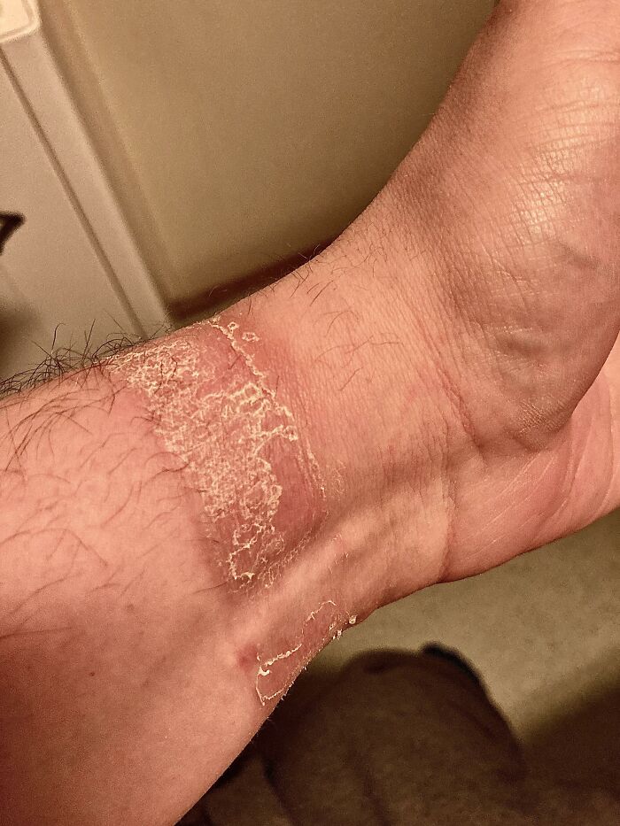 Let Me Introduce To You: My Wrist After Wearing Any Watch