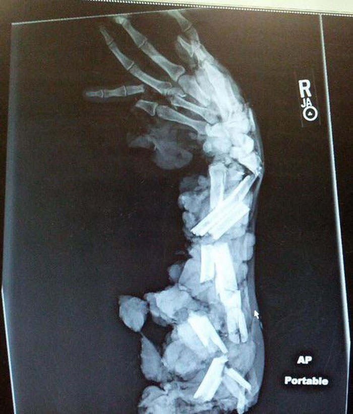 Radiografía del brazo de un hombre aplastado por una máquina de picar carne
