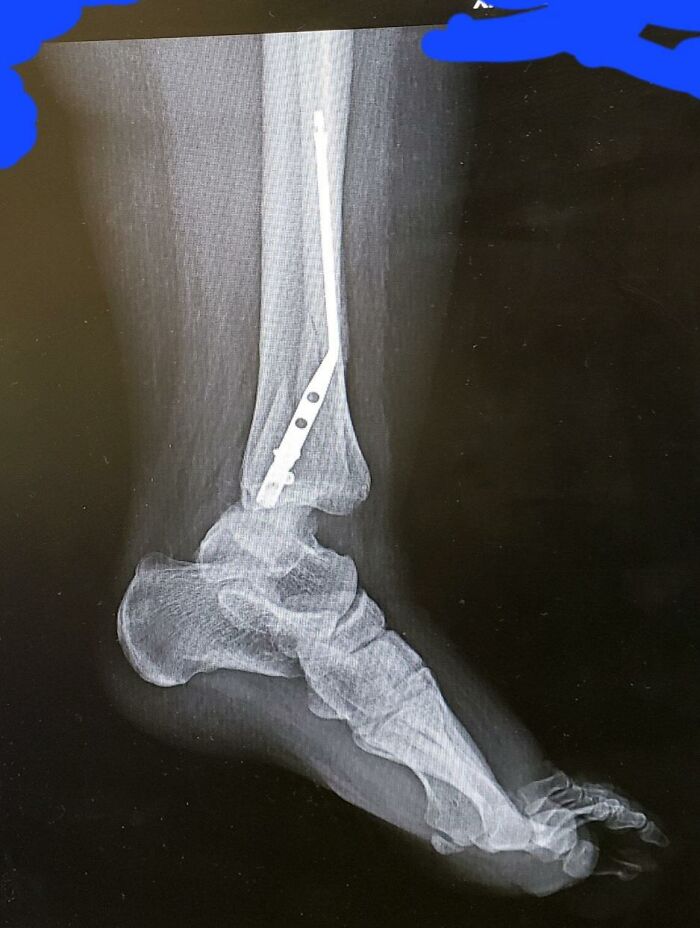 Fun Fact, If You Manage To Bend The Rod In Your Foot, The Rest Of It Shatters