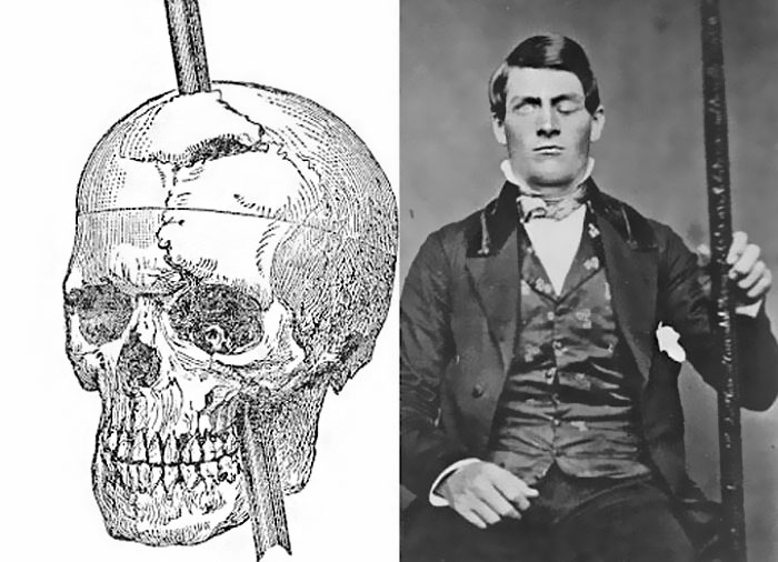 Phineas Gage. The Man That Survived A Tamping Iron Through The Skull. More On Him By Samonella Academy
