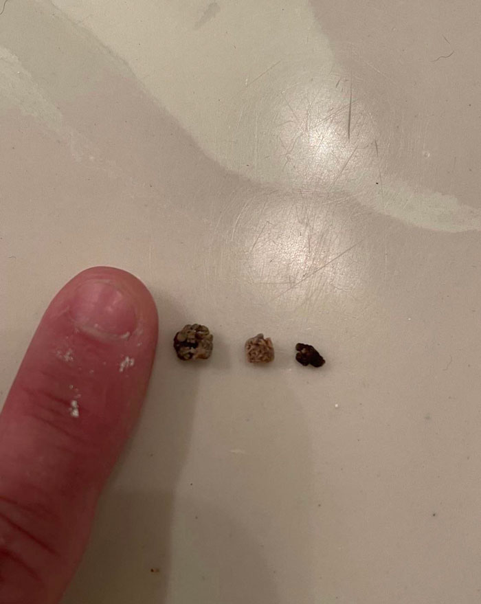 Kidney Stones Passed Recently. They Left The Kidneys And Have Been In The Bladder For About Three Years