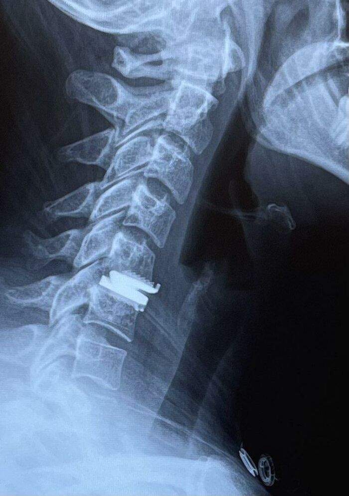 My Artificial Disc Replacement (C5-C6) Is Migrating Out Of My Spine