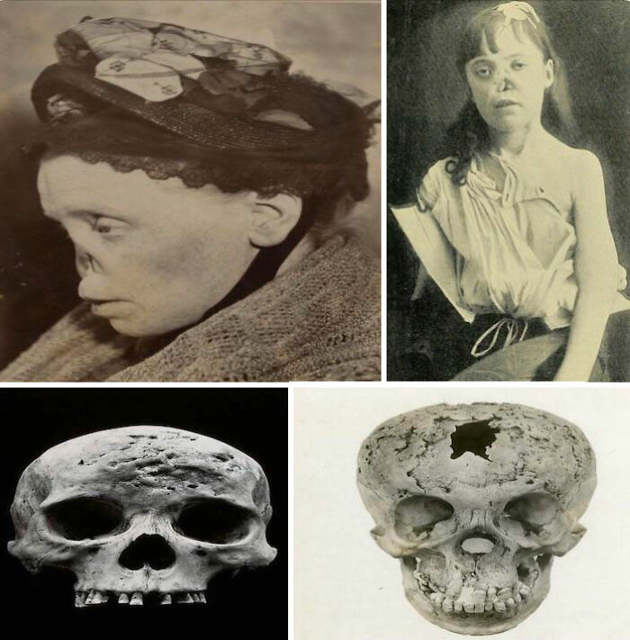 The Effects Of Severe Syphilis. The Disease Would Cause Painful Ulcers To Appear On The Face. These Ulcers Would Eat Away At The Bone & Cause The Nose To Collapse. Syphilis Would Attack The Nervous System And Brain In The Later Stages, Causing Blindness, Paralysis, Dementia, And Seizures