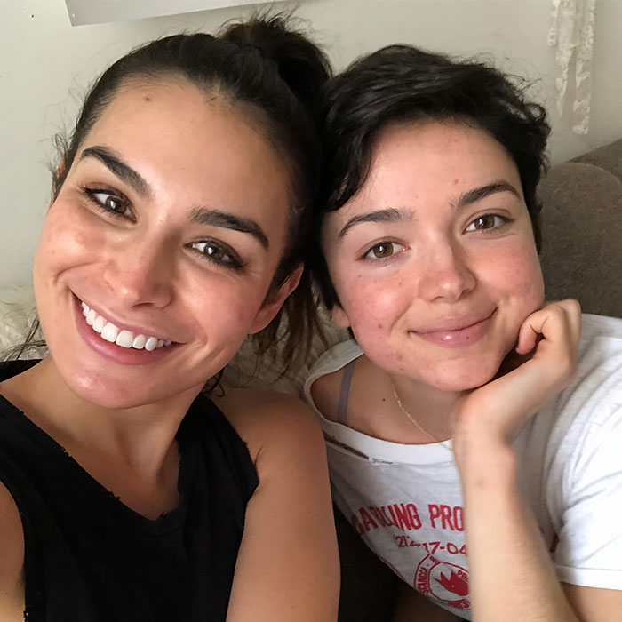 Ashley Iaconetti Embracing Her Acne Issues