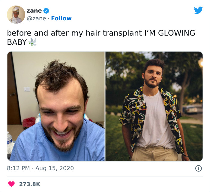Me Before And After My Hair Transplant