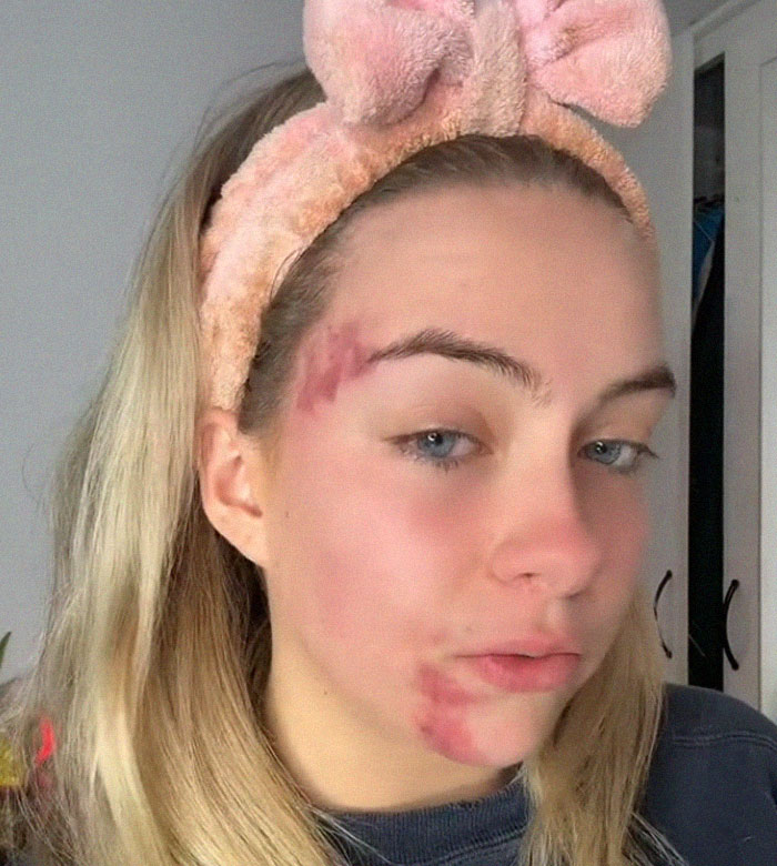 Woman's Face Starts Flaring Up Right Before Work, So She Films What It Looks Like To Raise Awareness