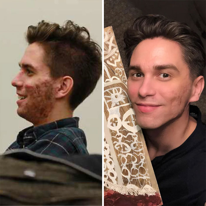 Severely Scarred Accutane Poster Skin Update And New Routine