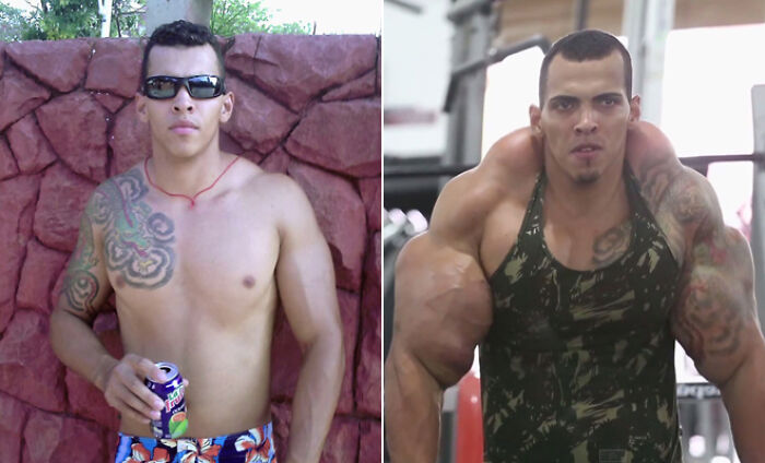 Before And After Pic Of Brazilian Amateur Bodybuilder Romario Dos Santos Who Regularly Injected His Arms With Synthol, An Oil Injection Used To Expand The Tissue In Muscles. Over A Short Period Of Time, Dos Santos’ Appearance Changed Drastically