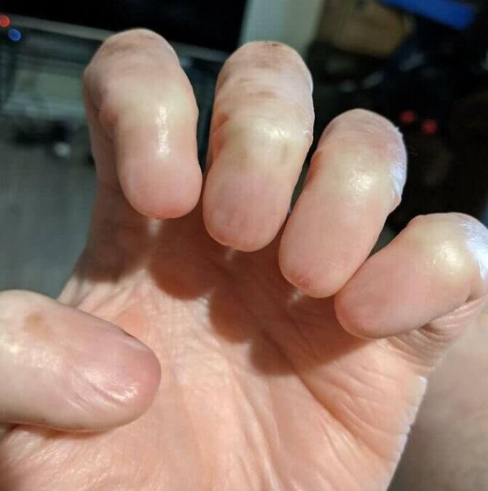 People Born With Anonychia Do Not Have Fingernails And Cannot Grow Them