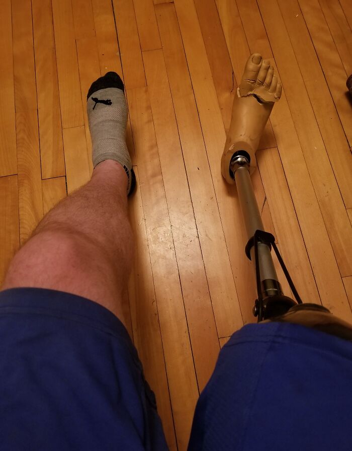 Lost The Toes On My Prosthetic Leg After My Friend's Dog Thought The Foot Was A Chew Toy