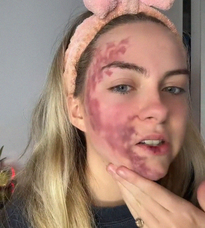 Woman's Face Starts Flaring Up Right Before Work, So She Films What It Looks Like To Raise Awareness