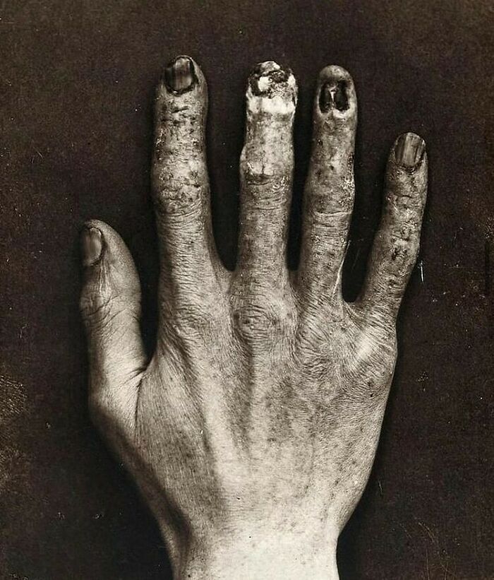 Hand Belonging To An X-Ray Technician At The Royal London Hospital, Which Shows The Damage From Radiation Exposure, 1900