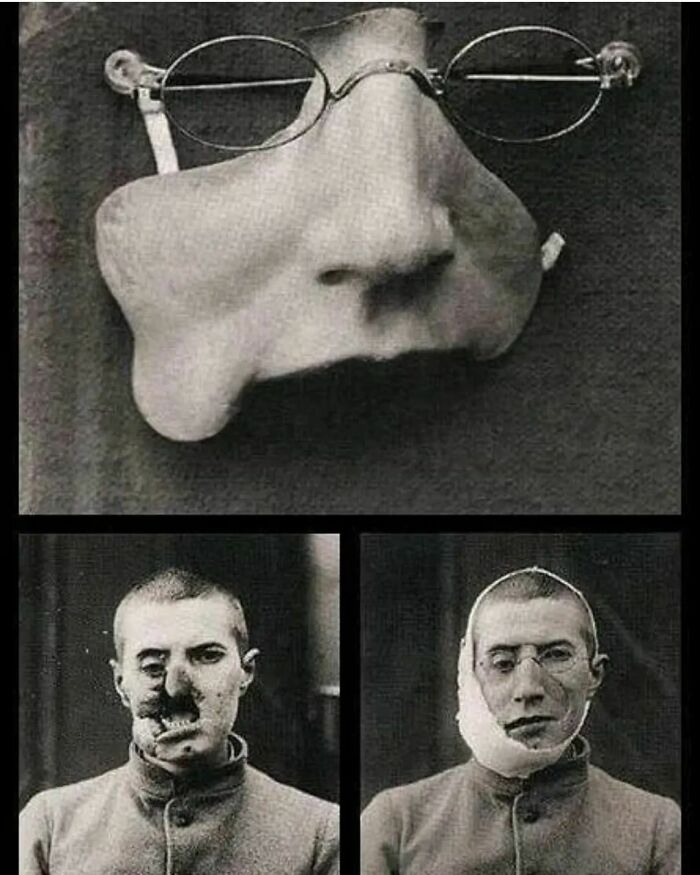 Prótesis facial para un soldado herido de la Primera Guerra Mundial, 1916