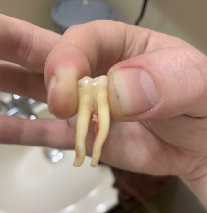 My Tooth Has Really Long Roots