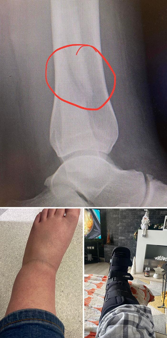 Broke My Fibula 2 Hours After Bragging To My Family That I’d Never Broken A Bone Before. On Christmas