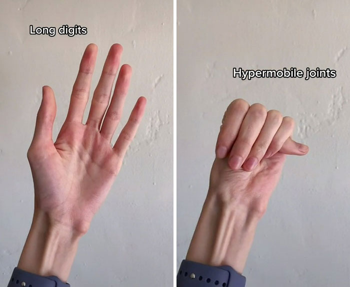 “Are We Really That Scary To Y’all?”: Person With Marfan Syndrome Goes Viral With 1M Views For Calling Out Horror Writers’ Choice In Monster Design “Are We Really That Scary To Y’all?”: Person With Marfan Syndrome Goes Viral With 1M Views For Calling Out Horror Writers’ Choice In Monster Design