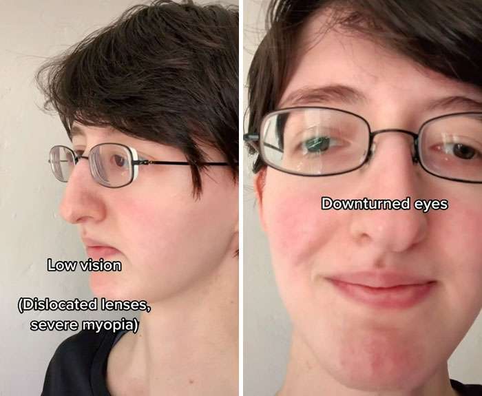 “Are We Really That Scary To Y’all?”: Person With Marfan Syndrome Goes Viral With 1M Views For Calling Out Horror Writers’ Choice In Monster Design “Are We Really That Scary To Y’all?”: Person With Marfan Syndrome Goes Viral With 1M Views For Calling Out Horror Writers’ Choice In Monster Design