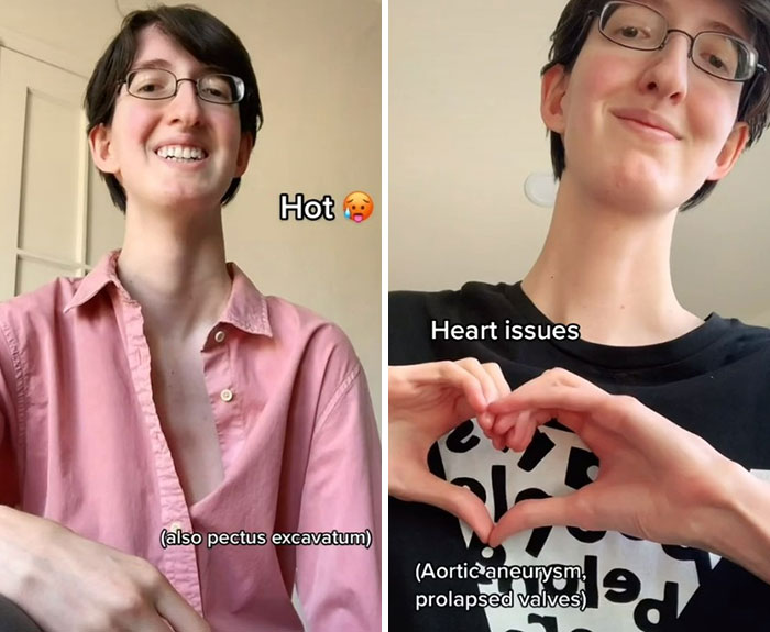 “Are We Really That Scary To Y’all?”: Person With Marfan Syndrome Goes Viral With 1M Views For Calling Out Horror Writers’ Choice In Monster Design “Are We Really That Scary To Y’all?”: Person With Marfan Syndrome Goes Viral With 1M Views For Calling Out Horror Writers’ Choice In Monster Design