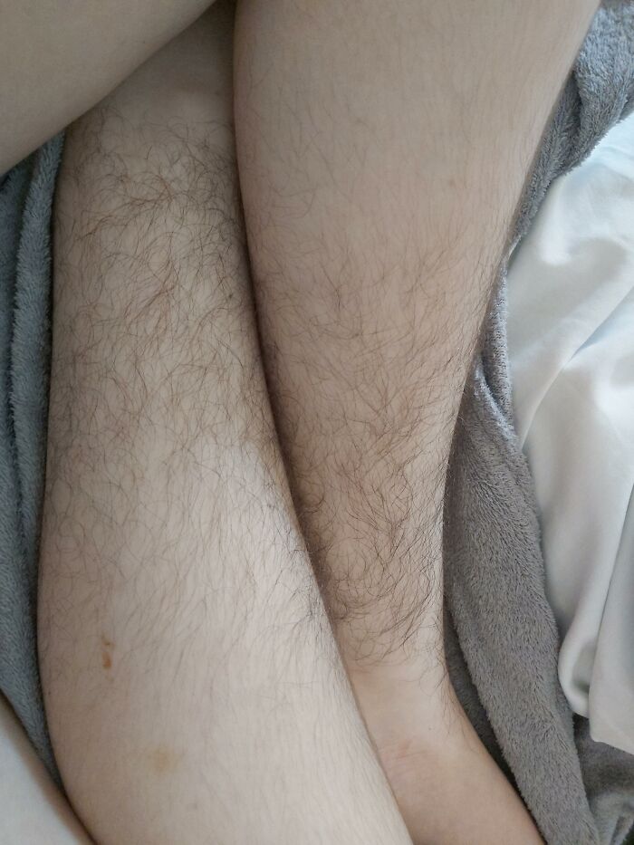 I Got Hospitalized Yesterday, While I Was Unconscious At The Bed, The Doctor Decided To Tell My Mom "Having This Much Leg Hair Is Completely Unnatural, She Should Check That Out"