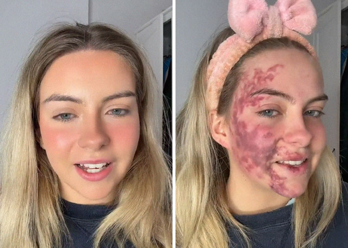 Woman’s Face Starts Flaring Up Right Before Work, So She Films What It Looks Like To Raise Awareness