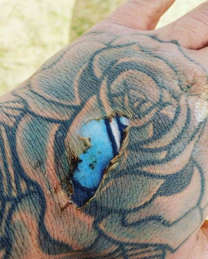 Qué ocurre cuando te quemas un tatuaje descolorido