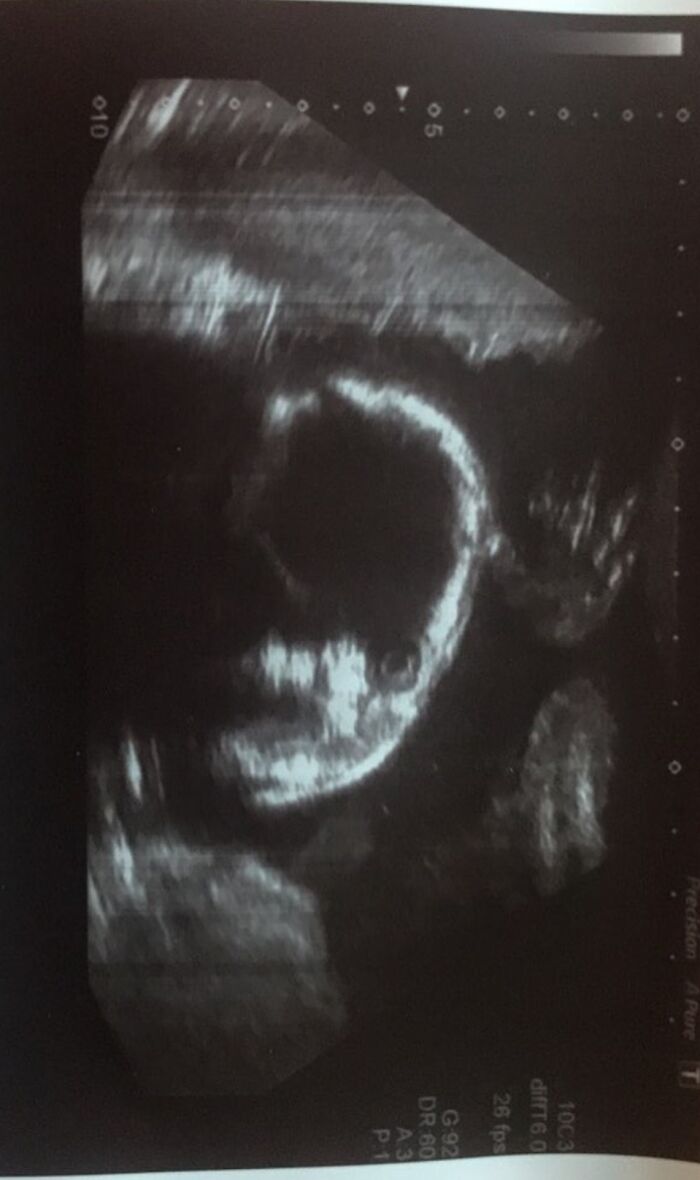 A Person I Know Posted Her Ultrasound Of Her Baby, It Is Genuinely Haunts Me
