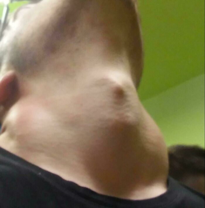 It Looks Like My Friend Has A Face Inside His Neck