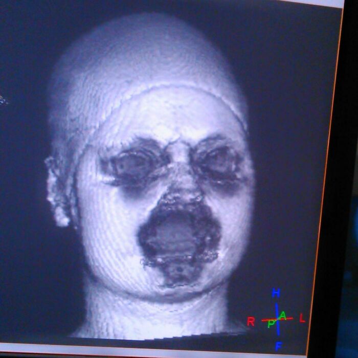 Así es como se ve una reconstrucción por resonancia magnética 3D de tu cara cuando usas maquillaje. Las partículas de metal en tu rímel, etc. perturban la señal de la máquina de resonancia magnética