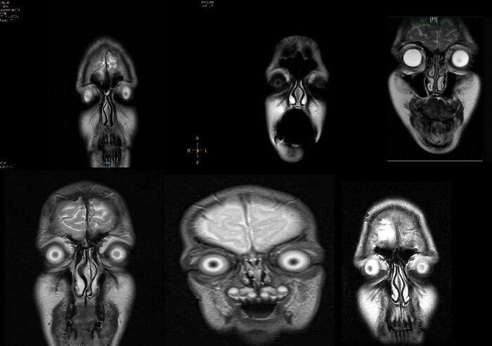 These Mri Scans