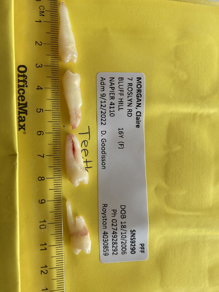 My Teeth From When I Had Surgery