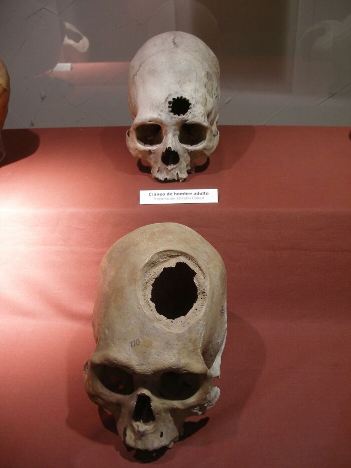 Archeological Remains Of Patients Of Brain Surgery Performed By Ancient Doctors Of The Inca Empire In The 15th Century