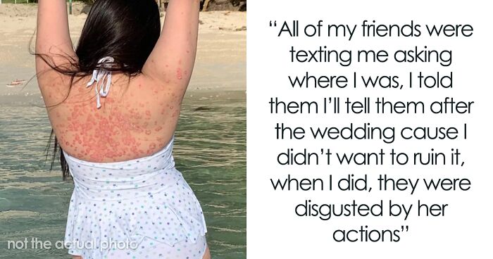 Woman Leaves “Friend’s” Wedding After She’s Called Out For Not Covering Up Her Skin Condition