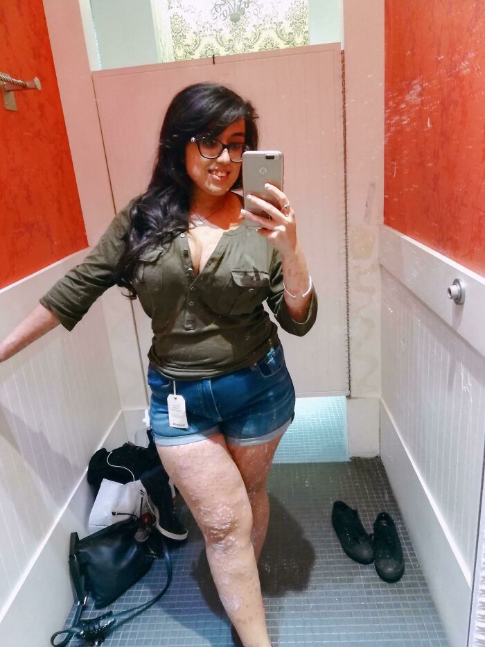 I Have A Severe Case Of Psoriasis, And Just Worked Up The Courage To Buy My First Pair Of Shorts