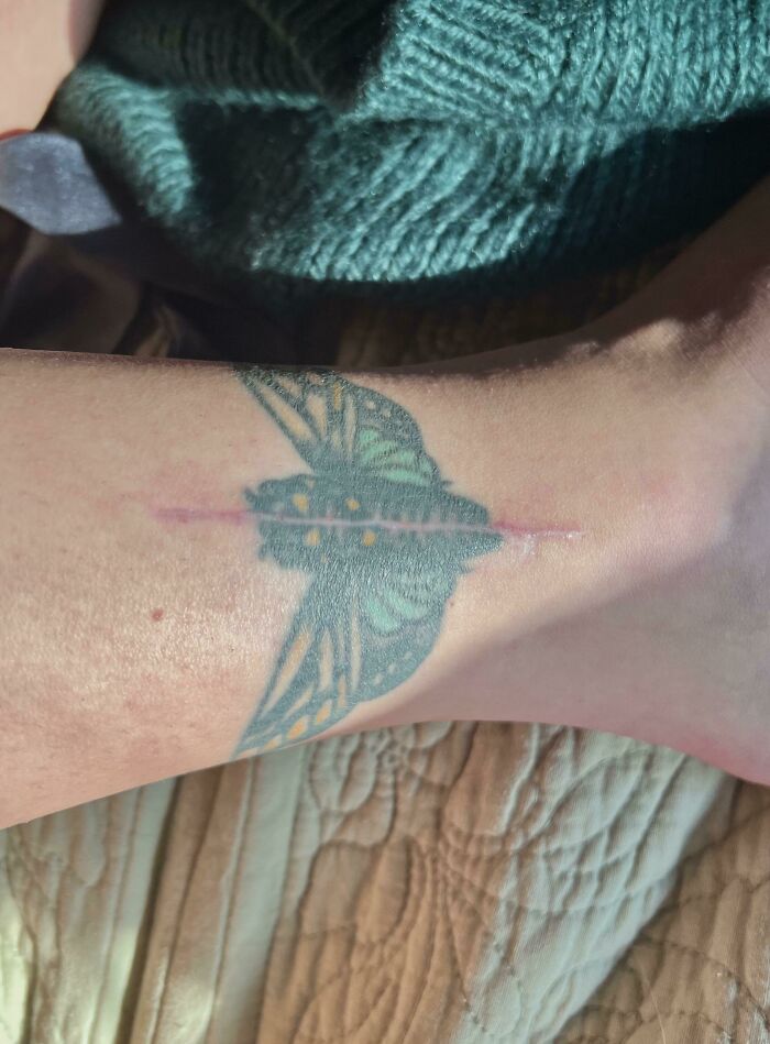 This Surgery Required An Incision Right Through The Center Of My Tattoo