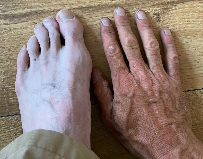 I Work Outdoors, This Is The Color Difference Of My Hand And My Foot