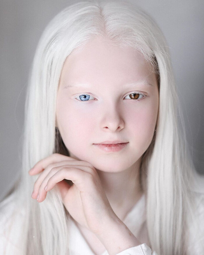 Meet Amina Ependieva – A Chechen Girl Who Is Admired For Her Unusual Beauty - She Is Diagnosed With Two Rare Genetic Conditions: Albinism In Which She Lacks The Melanin Pigment Making Her Skin And Hair Extremely White, And Heterochromia In Which Her Eyes Are Different In Colour