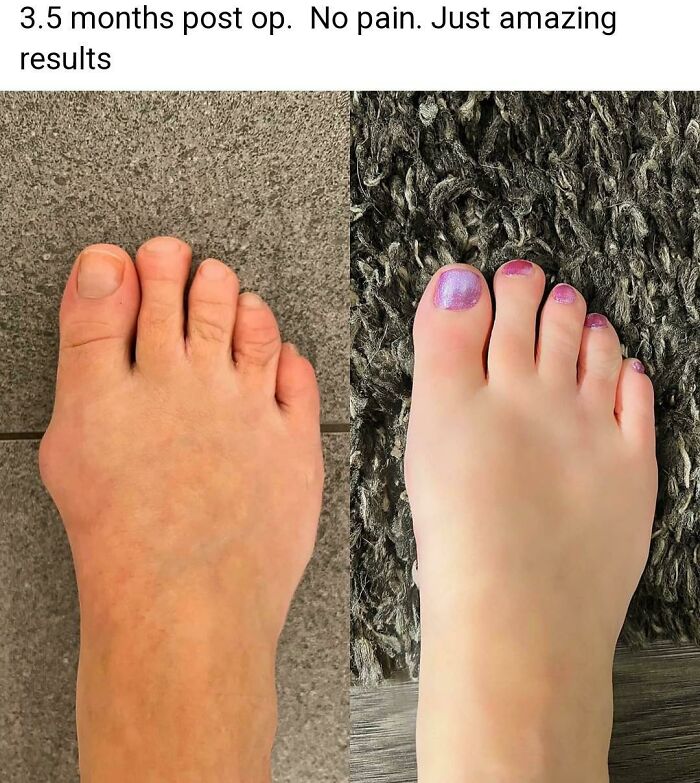 (From A Foot Surgery Support Group) She Airbrushed Her Toe Wrinkles Out Wtf