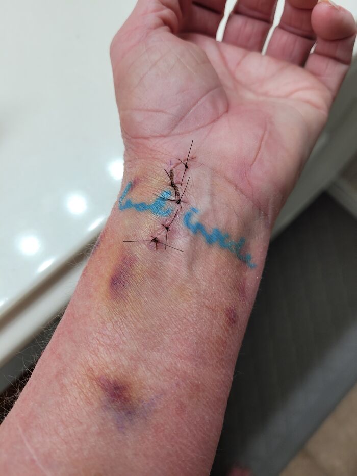 Close-up of tattooed wrist with stitches and bruises.