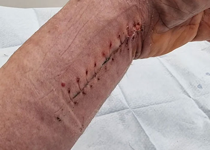 Orificios de la cicatriz post-operatoria. Parece un balón de fútbol americano