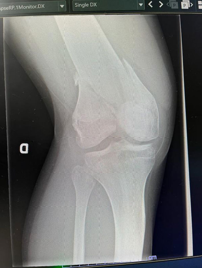 X-Ray Of My Femoral Fracture (Yes, The Bone Is Slipt In Two)