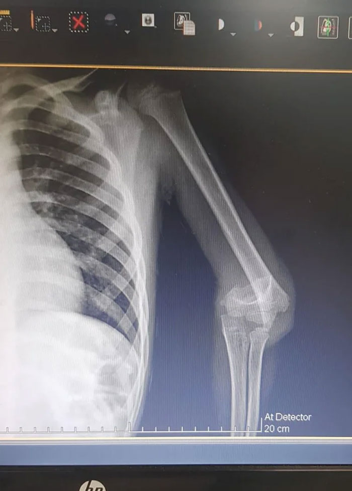 Humeral Fracture