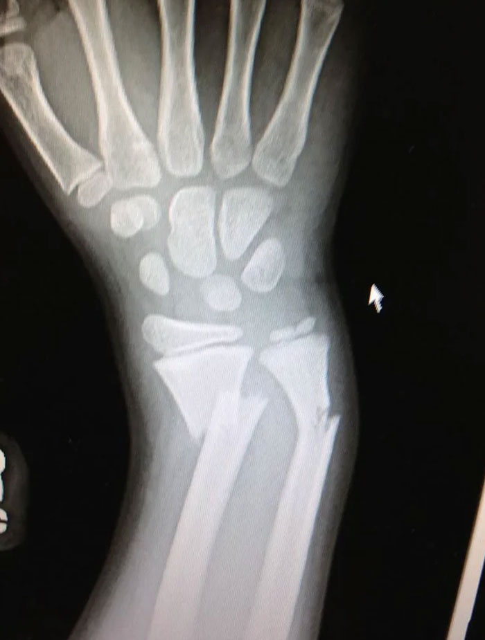 Radiografía de cuando me rompí el brazo de niño